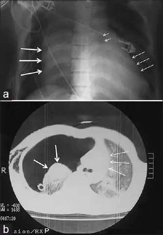 a)Collapsed right lung , left deviated trachea , and shifted heart  b) chest illustrating  collapsed right lung  and shifted heart