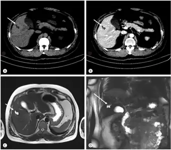 Bileduct dilatation in segment 5 arrow a,b) CT, c) MRI, d) MRCP