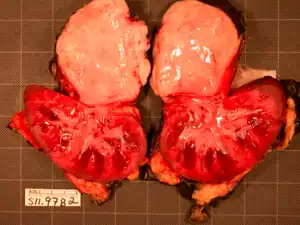 Renal ganglioneuroma