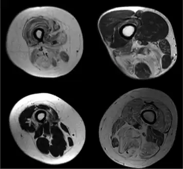 Radiologic imaging in neuromuscular disorders