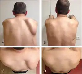 a,c)Medial scapular winging on the right side preoperatively  b,d)post-operatively