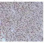 IHC staining for Oligodendroglioma