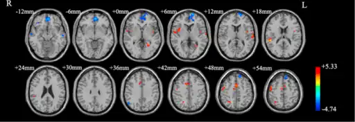 Brain regions showing different functional connectivity between obsessive–compulsive disorders and  controls