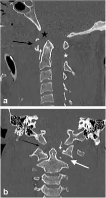 a,b)Jefferson’s fracture in a  male victim of a motor vehicle accident