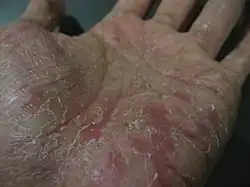 Palmar dyshidrosis