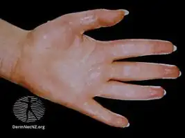 Palmar hyperhidrosis