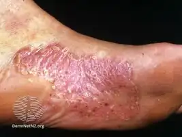 Palmoplantar pustulosis