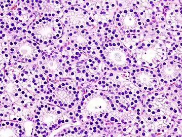 Histopatholgical image of parathyroid adenoma in a patient with primary hyperparathyroidism. Hematoxylin and eosin stain. Another view of the same lesion