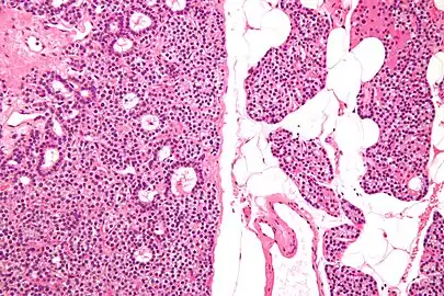 Normal parathyroid gland with prominent adipose tissue is seen on the right of the image.-High magnification