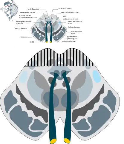 Cross section of midbrain. The area affected in Parinaud's syndrome is indicated by the striped region.