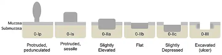 Paris classification of colorectal neoplasms.