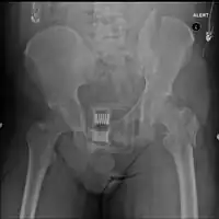 Pelvic fracture