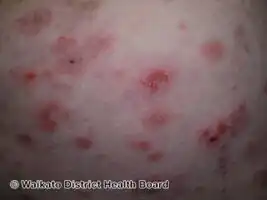 Pemphigus foliaceus