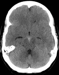 Perimesencephalic subarachnoid hemorrhage