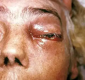 Mucormycosis in eye