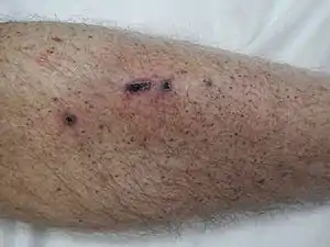 Petechia on the lower leg from thrombocytopenia