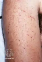 Meningococcal petechiae