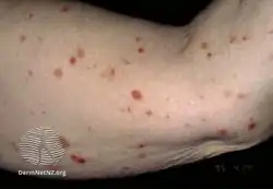 Pityriasis lichenoides chronica