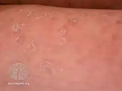 Pityriasis lichenoides chronica