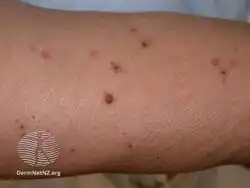 Pityriasis lichenoides et varioliformis acuta