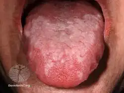 Plaque in mouth - lichen planus