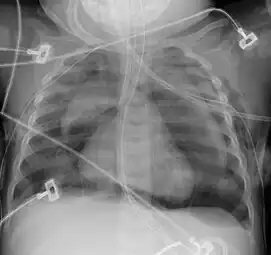 Pneumomediastinum with angel wing sign