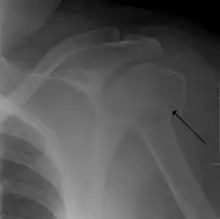 Proximal humerus fracture