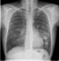 Cryptococcosis lung