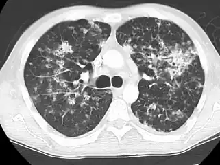 Tuberculosis of the lungs