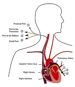 Diagram of Pulmonary artery catheter (PAC)