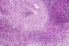 Pulmonary tuberculosis featuring necrotizing granulomas, H&E stain.