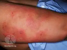 Heparin induced thrombocytopenia