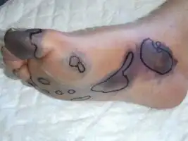 Purpura fulminans
