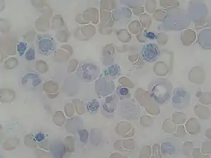 Bone marrow aspirate: ring sideroblasts