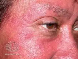 Rosacea