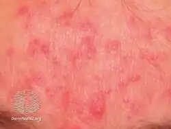 Rosacea