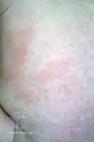 Rubella rash