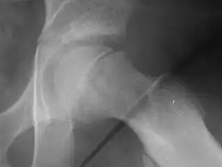 Xray showing SCFE