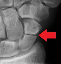 A more obvious scaphoid fracture on a scaphoid view X ray