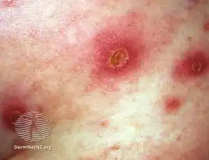 Ecthyma