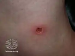 Ecthyma