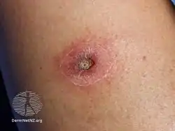 Ecthyma