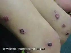 Ecthyma