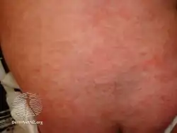 Roseola