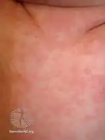 Roseola