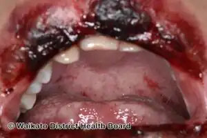 Severe enteroviral stomatitis