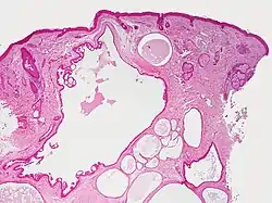 Hidrocystoma histology