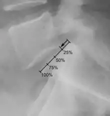 X-ray of measurement of spondylolisthesis at the lumbosacral joint, being 25% in this example.