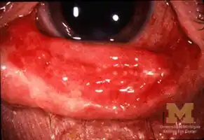 Conjunctivitis in SJS