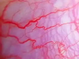 Dilated bulbar vessels in Sturge–Weber syndrome